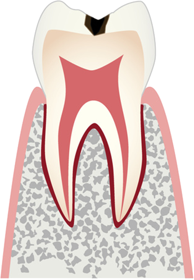初期の虫歯・エナメル質齲蝕