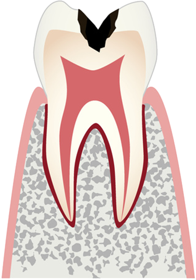 歯の内部まで進行した虫歯・象牙質齲蝕